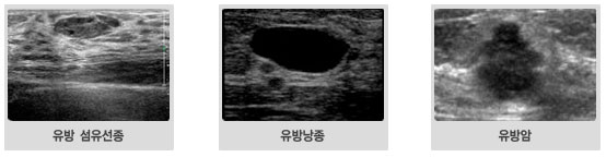 유방초음파사진